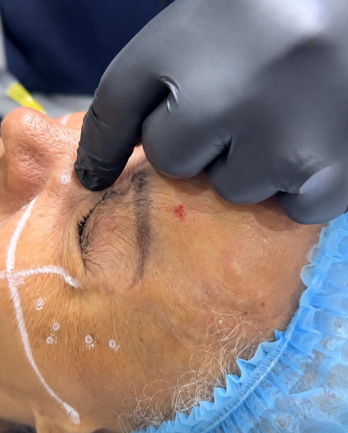 Aplicación de Botox rejuvenecedor