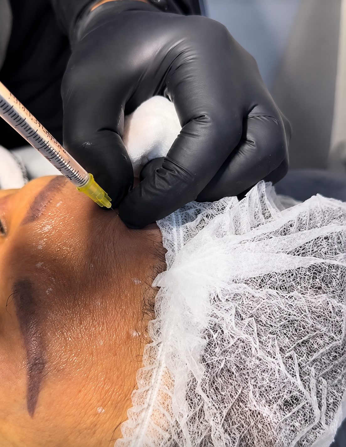 Procedimiento de medicina estética en Bellaser