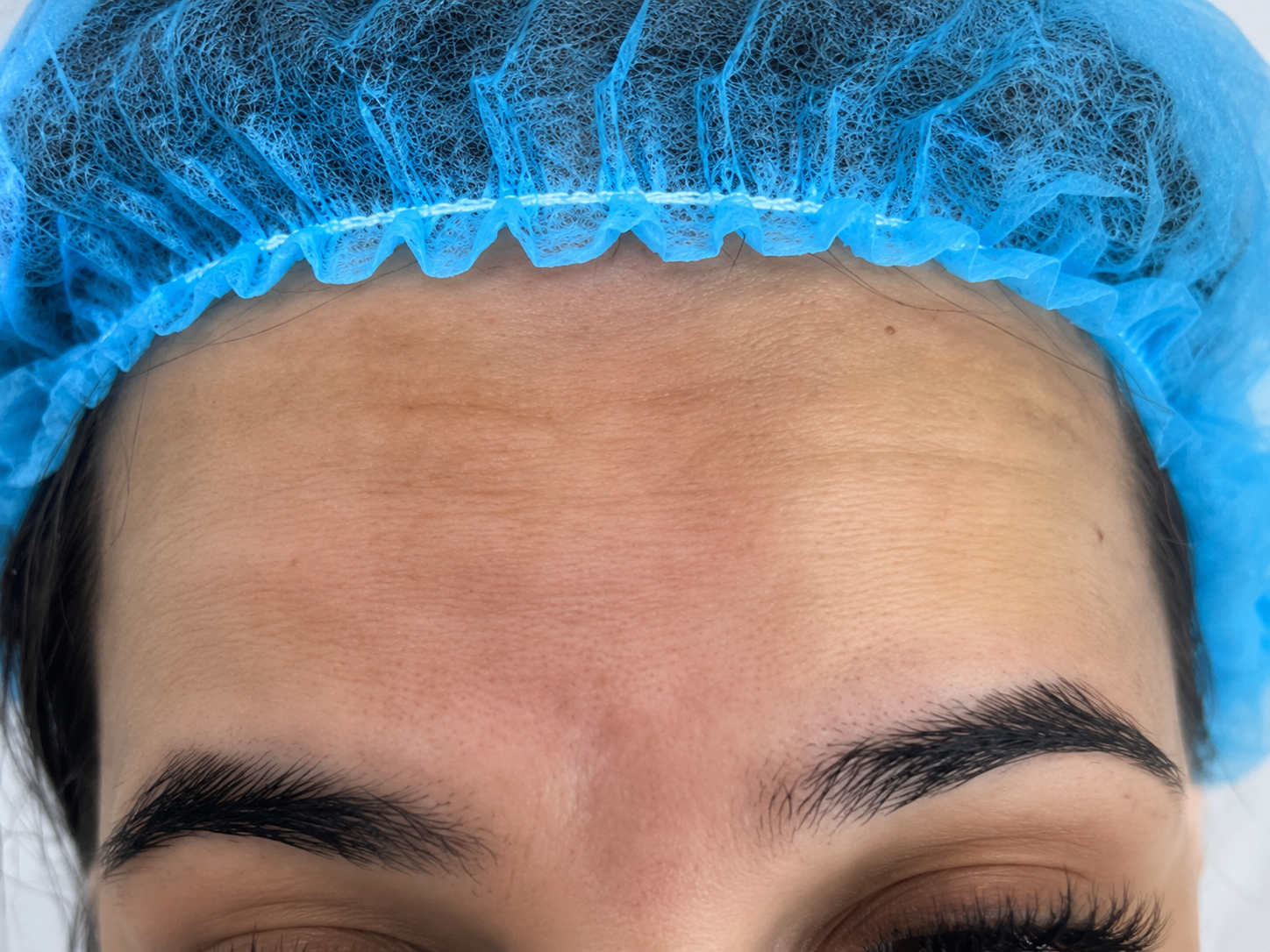Paciente antes del tratamiento de Botox rejuvenecedor