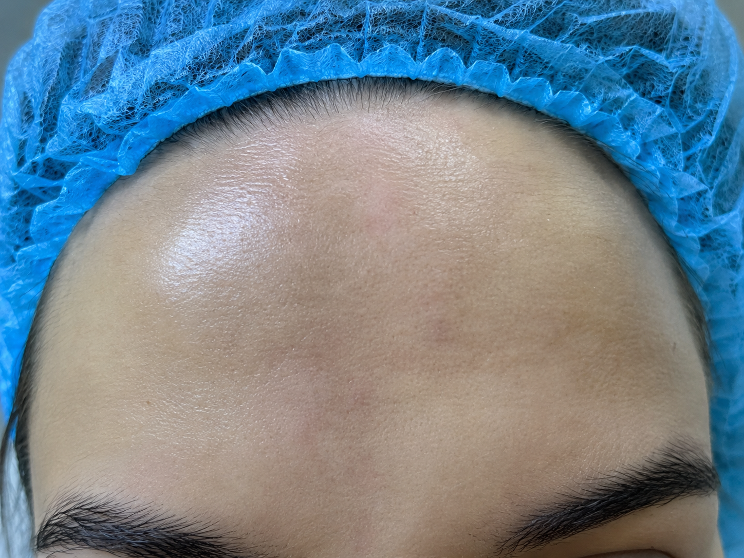 Paciente después del tratamiento de Botox rejuvenecedor