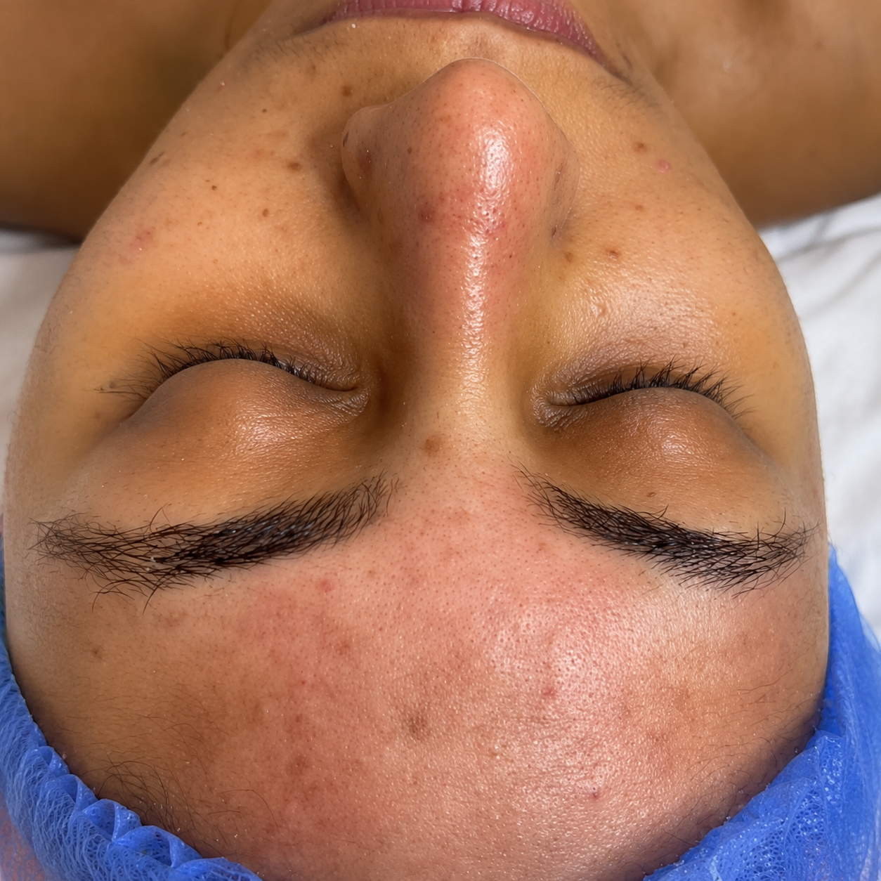 Paciente antes de la limpieza facial profunda