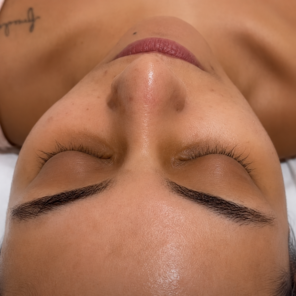 Paciente después de la limpieza facial profunda